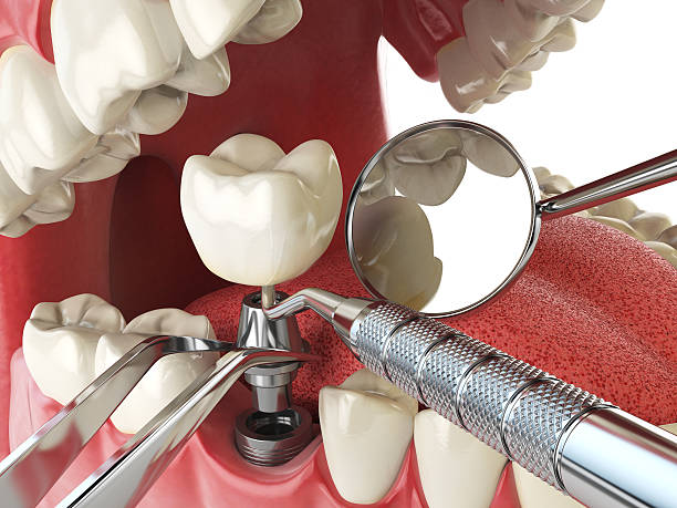 Best Emergency Dentist for Lost Fillings or Crowns in Albertson, NY